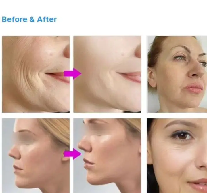 2024 EMRF face lifting machine Facial Muscle Beauty Equipment Face Machine