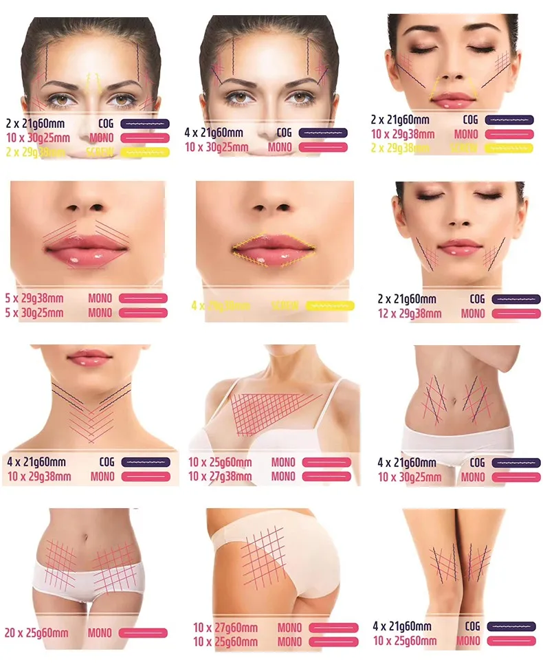 Best Selling Face Lifting 29g 25mm Medical Mono Pdo Thread For Wrinkles Removal And Skin Tightening