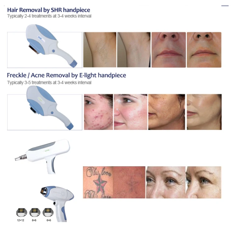 
best selling products elight ipl rf beauty equipment / e-light ipl rf+nd yag laser multifunction machine ipl china 