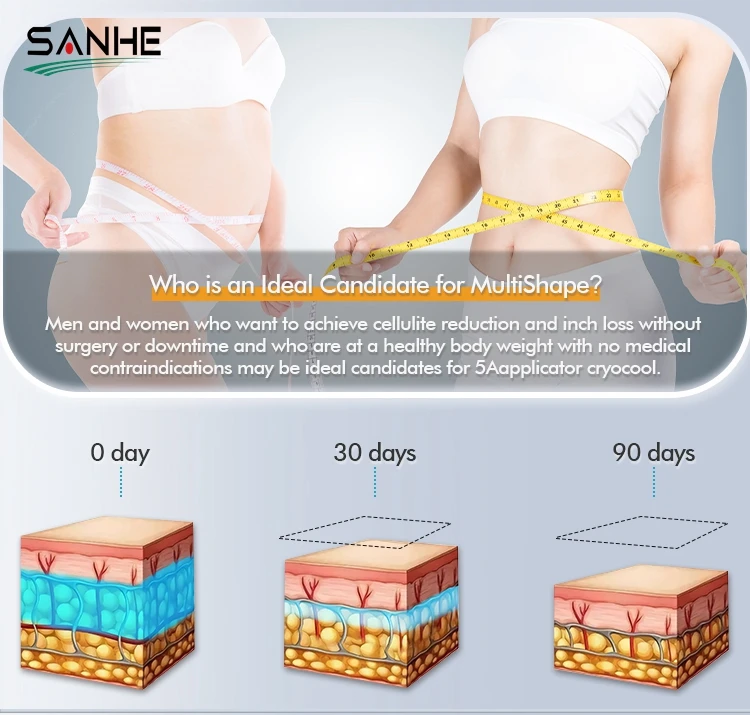 SANHE 5 handles cellulite removal Cryolipolysis 360 Surrounding cryo fat freezing slimming machine
