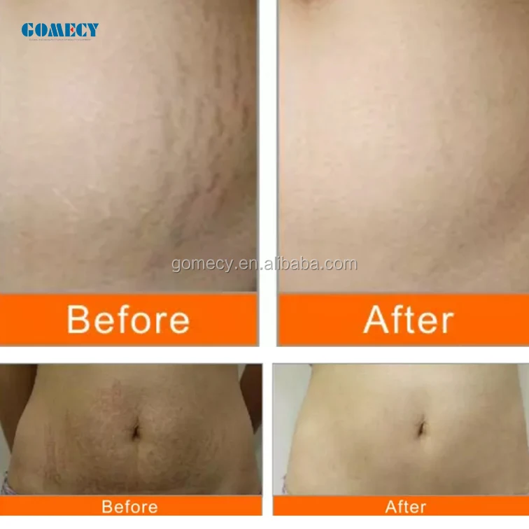 GOMECY mesogun mesotherapy gun hot selling  hair treatment meso gun with factory price