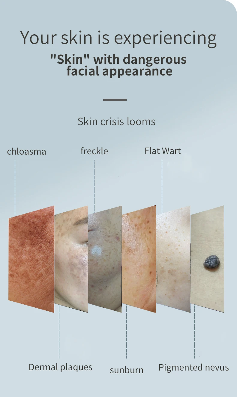 5g Freckle Removal Device Pigment Removal Device Portable Nevus Remove Machine