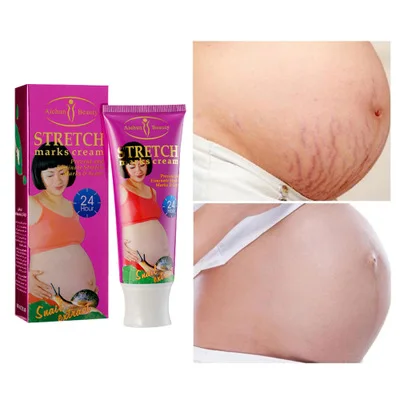 
Wholesale Natural mild non irritating stretch mark cream to repair loose stretch marks on the abdomen 