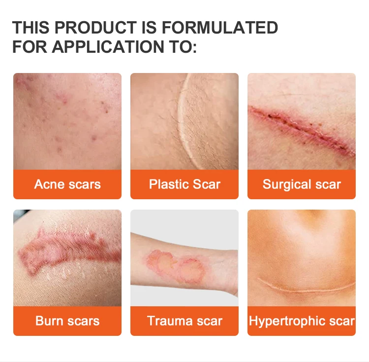 Factory Hot Sales Medical Gradetransparent Scar Removal Silicone Gel Patches Scar Removal Patch