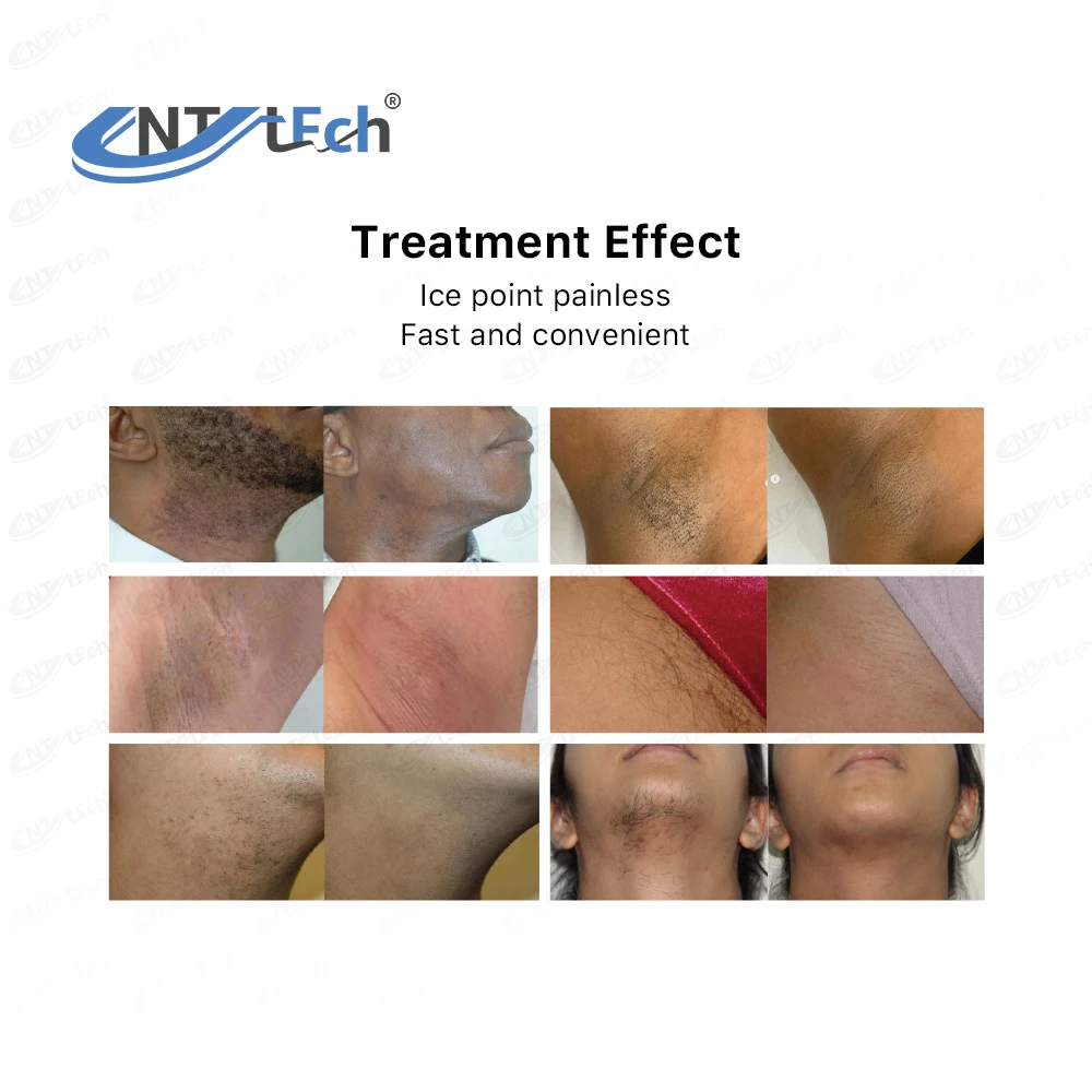 Aesthetic medicine 808nm diode laser hair removal permanent machine for hair removal pain free