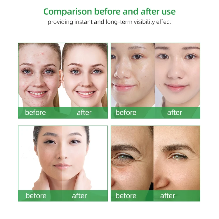 Diamond Dermabrasion Microdermabrasion Facial Care Hydra Machine