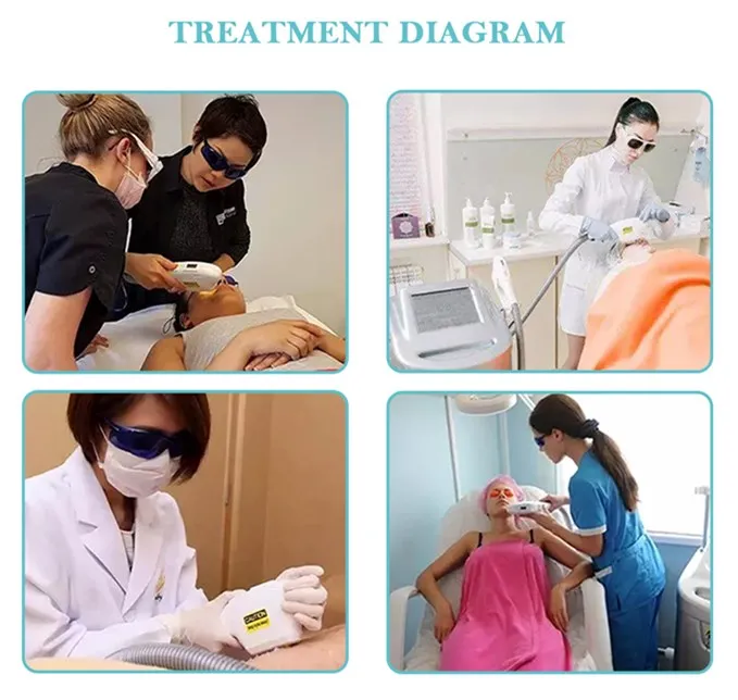 Омоложение кожи лазерное удаление волос SH HR идеальный завод отличное послепродажное обслуживание качество гарантировано