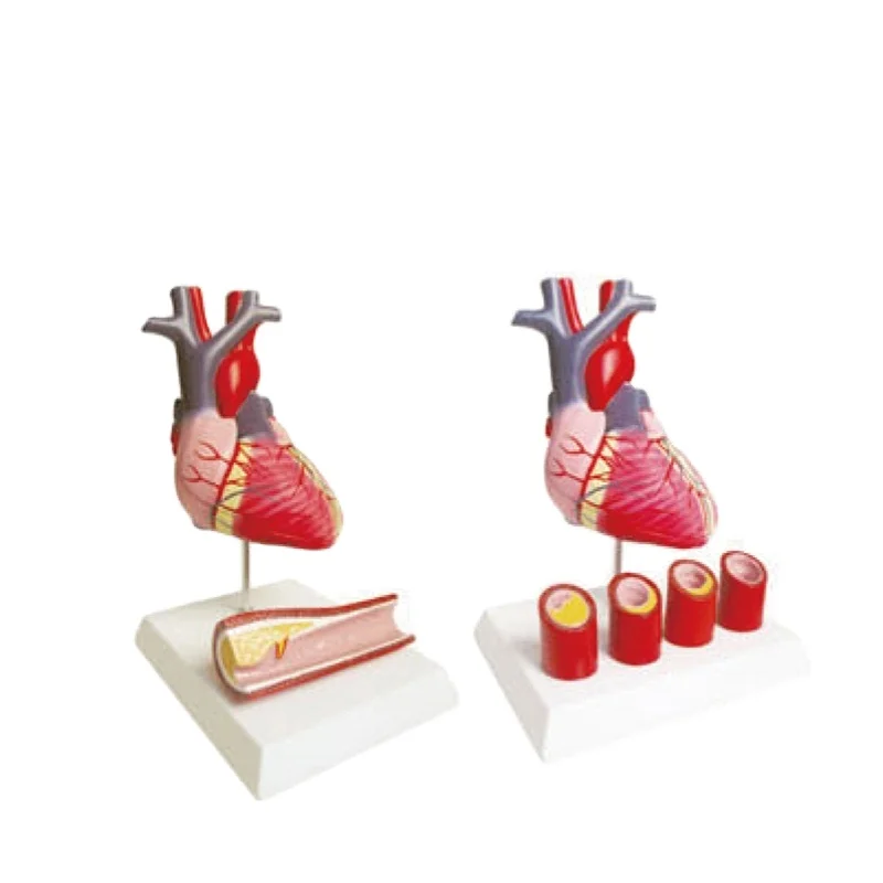 Natural Size Anatomical Model of Heart with Pathological Artery