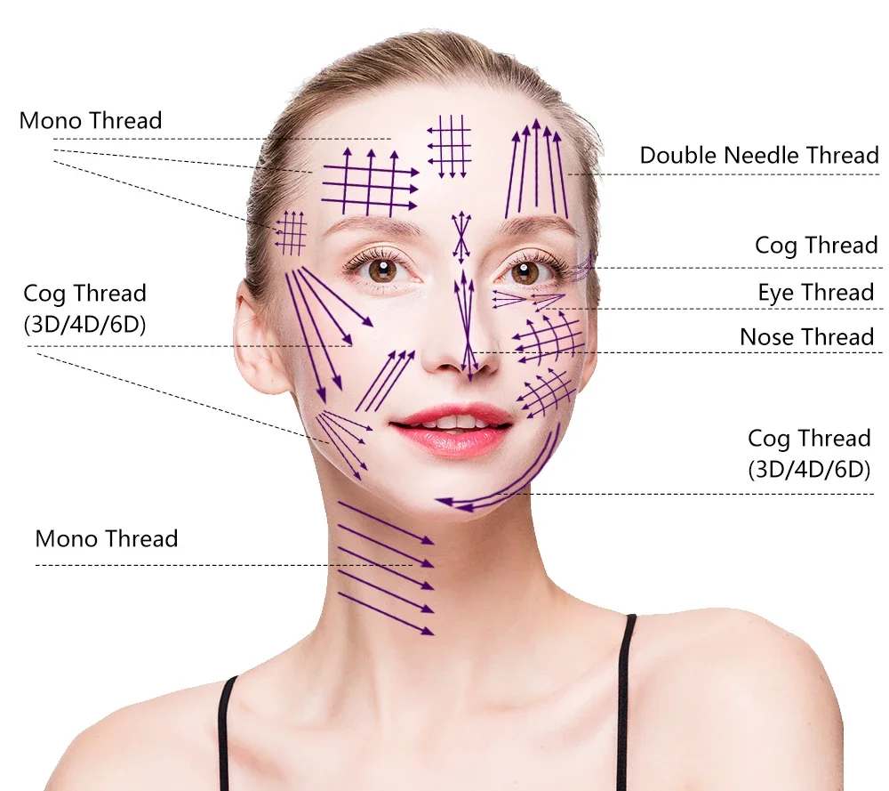 Best quality Korea Surgical suture thread PLLA/PCL/PDO COG  beauty pdo lifting threads hilos