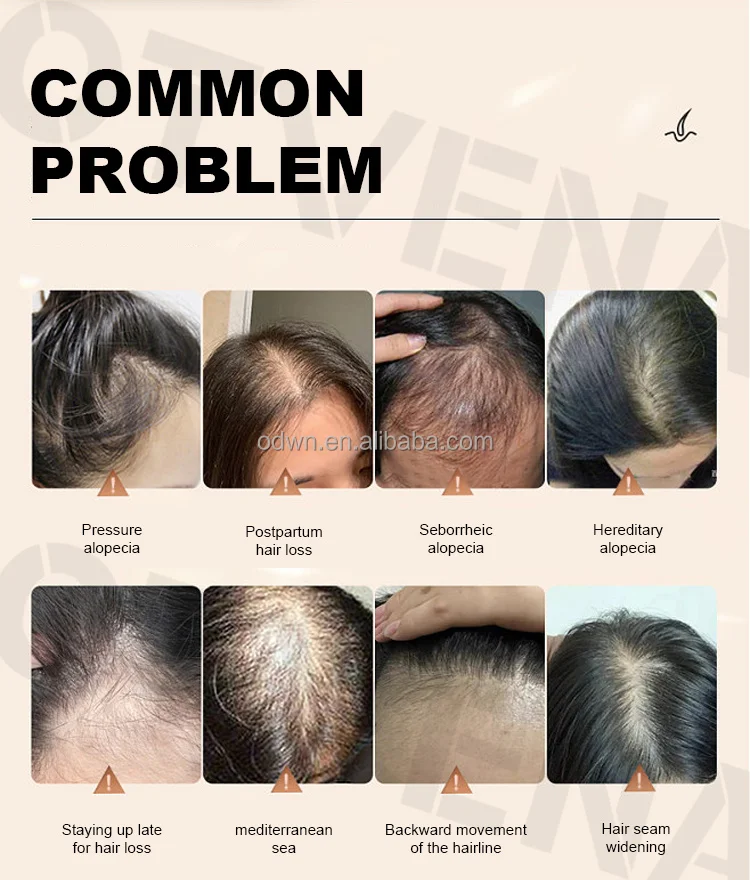 Women Men Anti Hair Loss Treatment Organic Ginger Hair Growth Oil For Hair Regrowth Spray