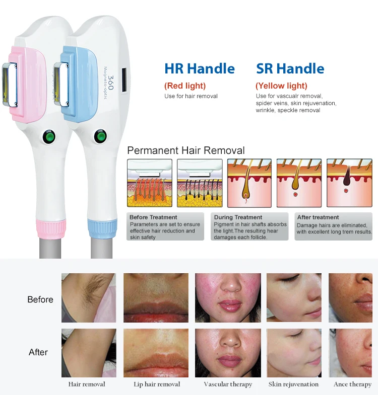 New portable IPL + Opt + SHR freckle whitening laser hair removal machine manufacturers direct supply