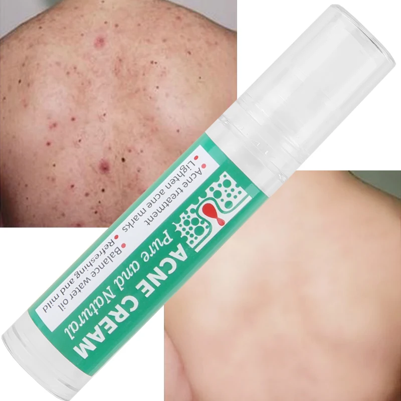 Custom Logo Skin Care Anti Aging Wrinkles Moisturiser Hyaluronic Acid Facial Firming Moisturising Aloe Vera Gel Anti Acne Cream