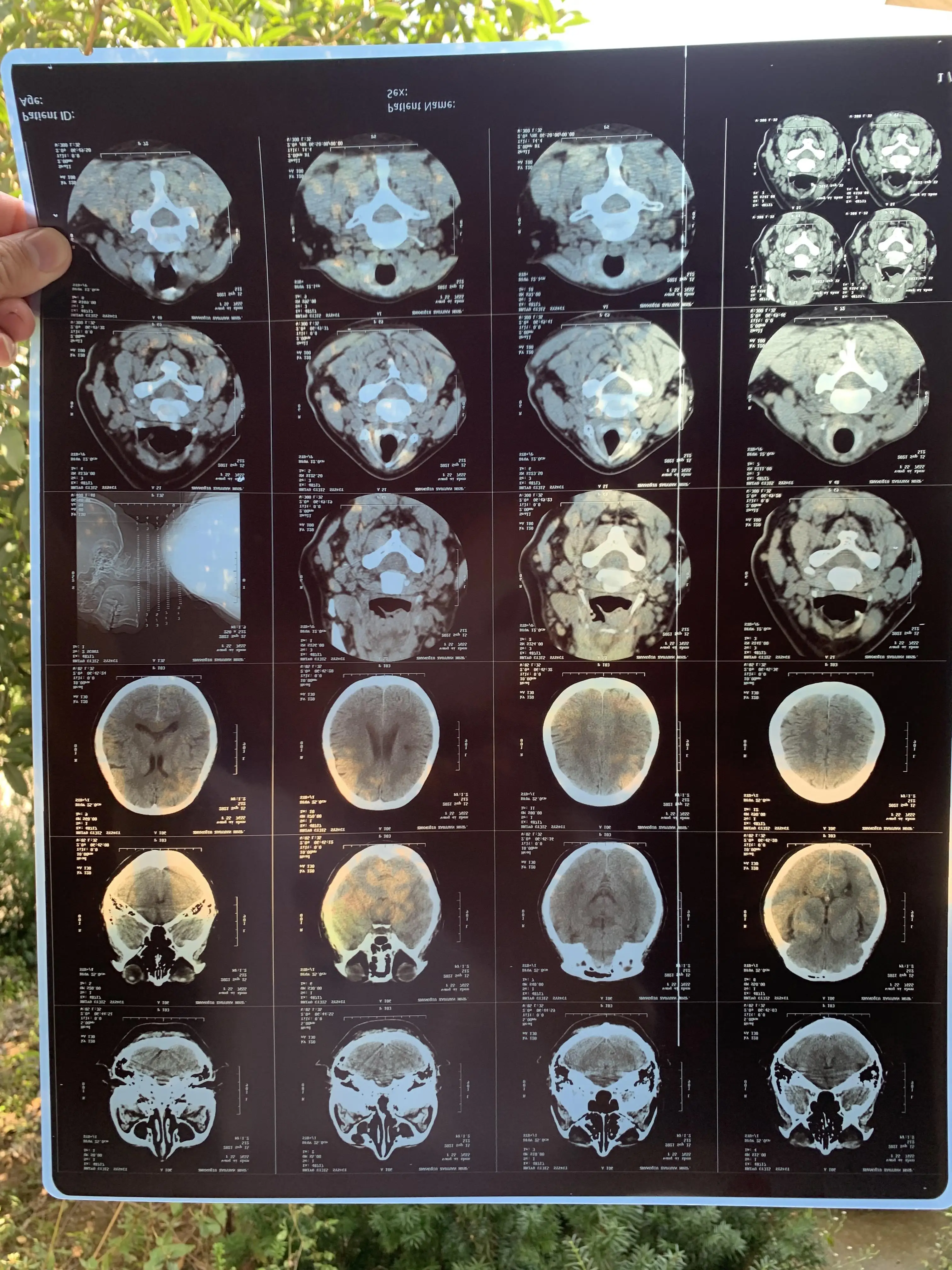 Wholesale A3 Custom Size Sheets Rolls Blue Inkjet Medical Film for Medical Image Printing X Ray CT, CR, DR, MTR, PET-CT etc.