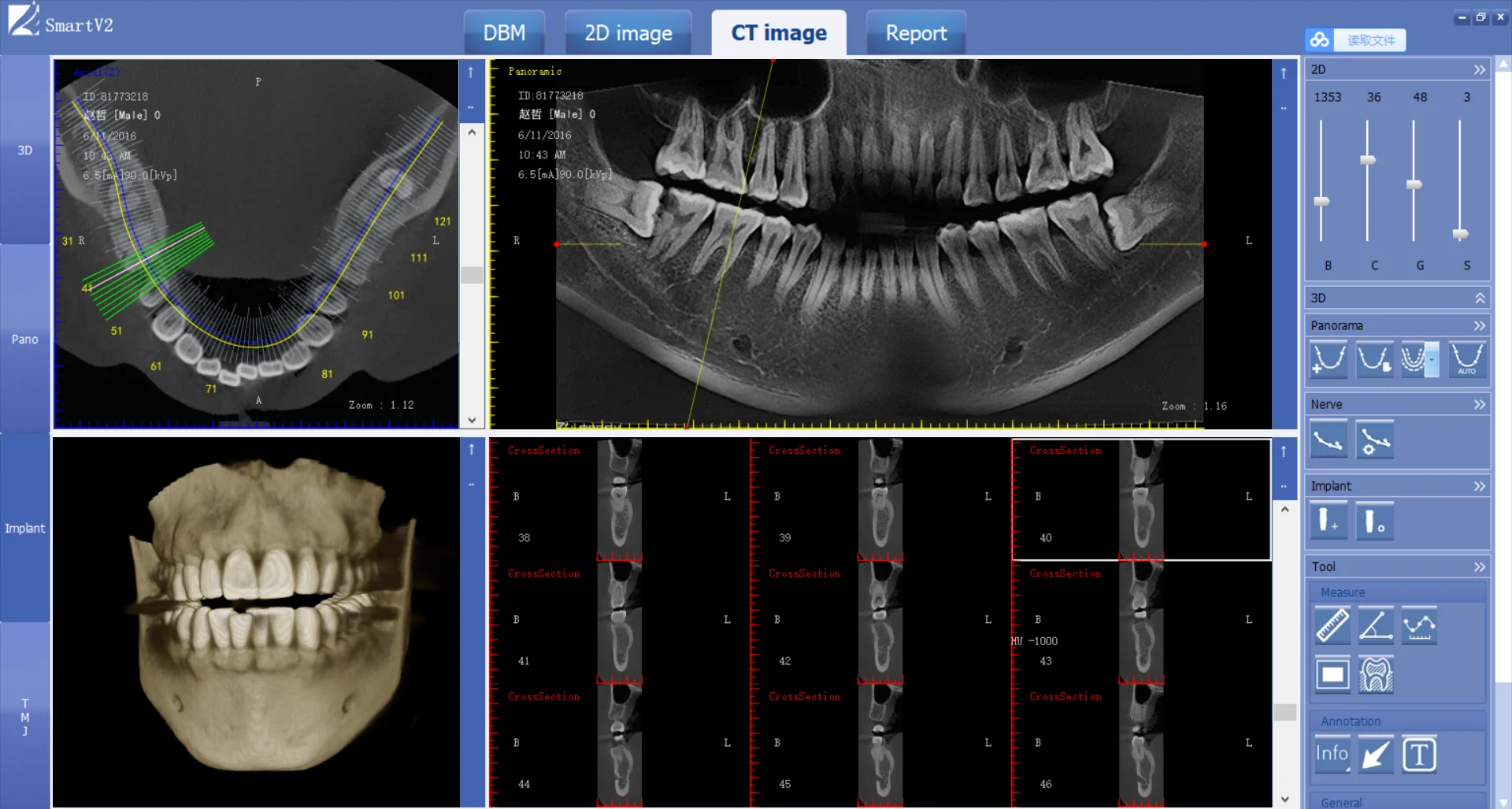 
Professional best selling Cone beam CT multifunctional dental CBCT Radiology Equipment 