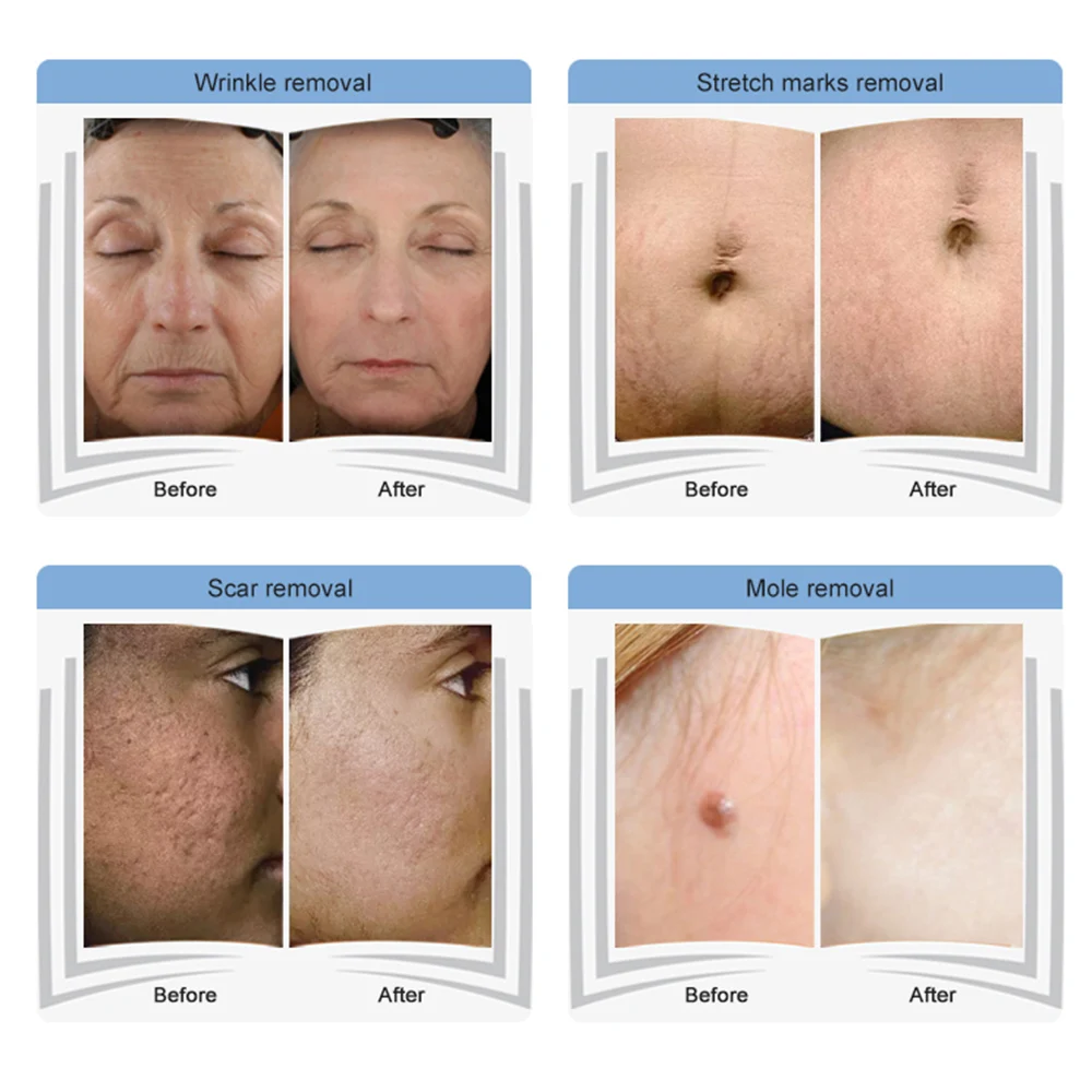 Wholesale Beauty Vaginal Rejuvenation Machines Co2 Fractional Laser Machine