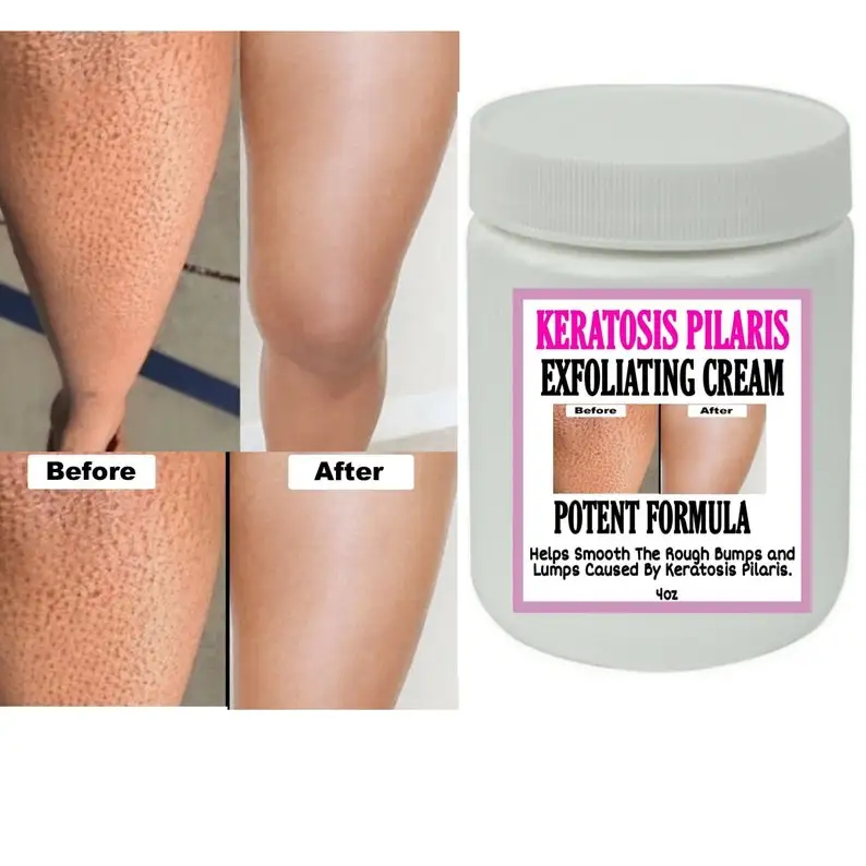 Strawberry Legs Cream Fades Strawberry Spots All Over Skin Smooth Strawberry Legs Exfoliating Cream