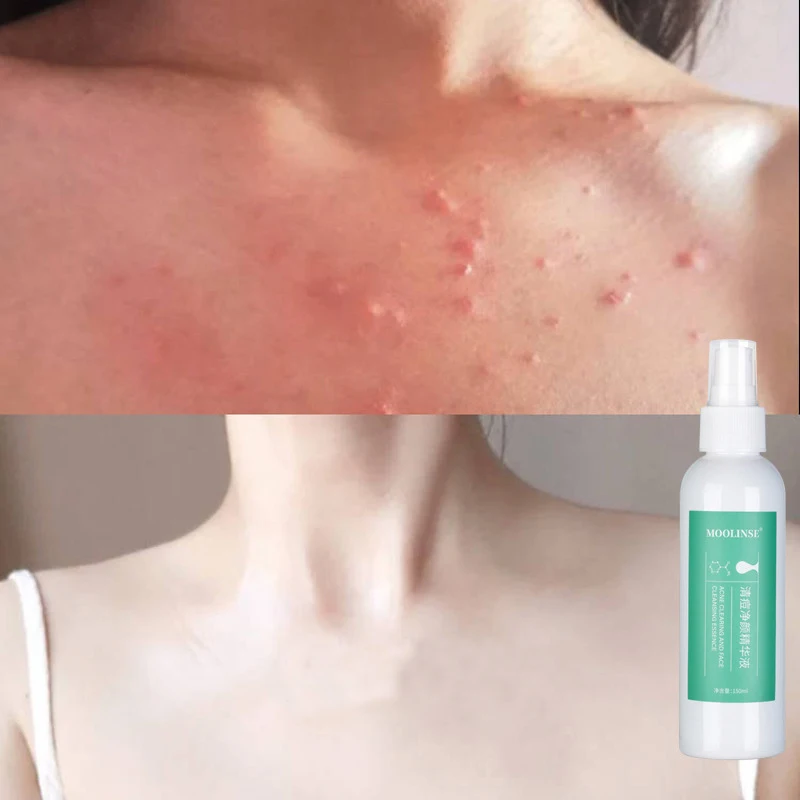 150 мл акне удаление на спине и груди клещей следы спрей