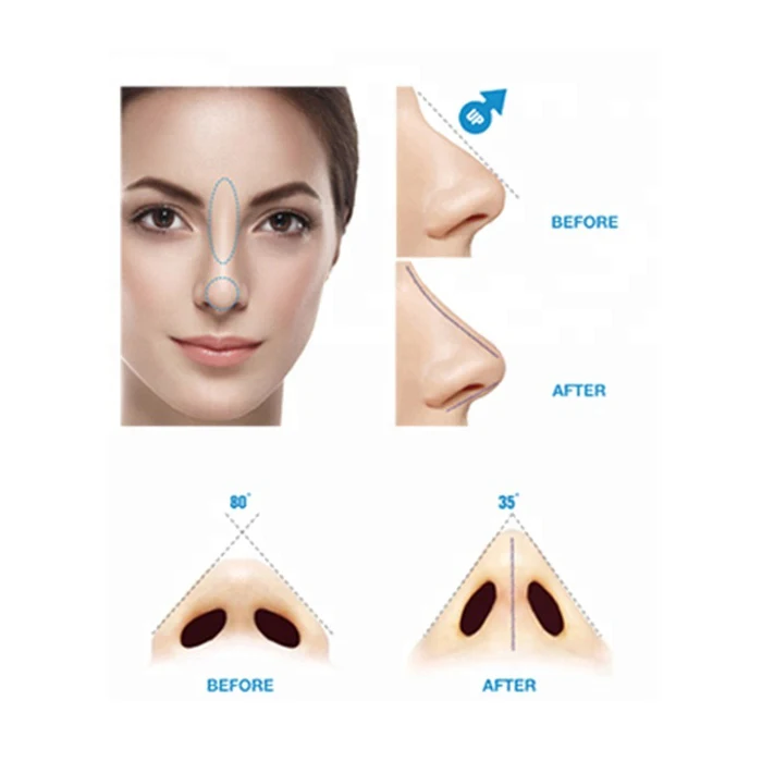 High Quality Face Lift Korean Thread 21g 100mm Cog 4d Hilo De Pdo Thread With Half-Blunt L Cannula