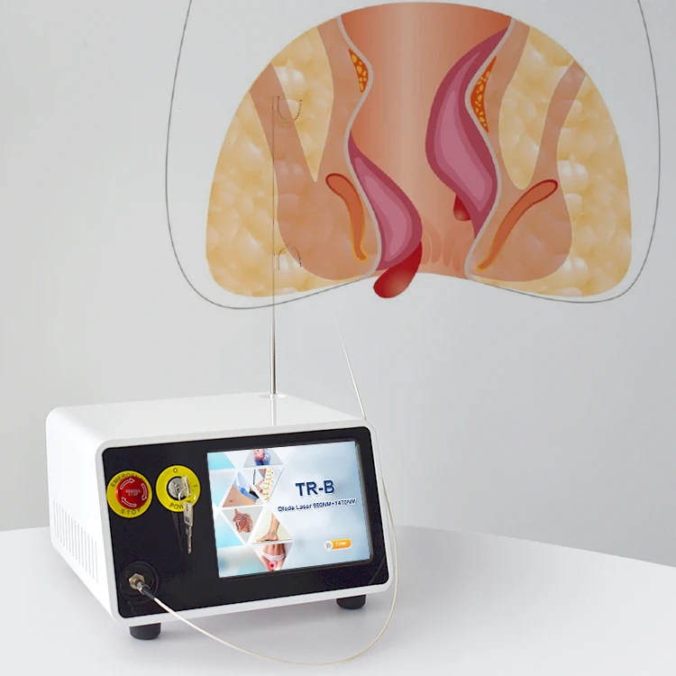 Dual wave 980nm 1470nm diode laser treatment hemorrhoid and hemorrhoid cutting