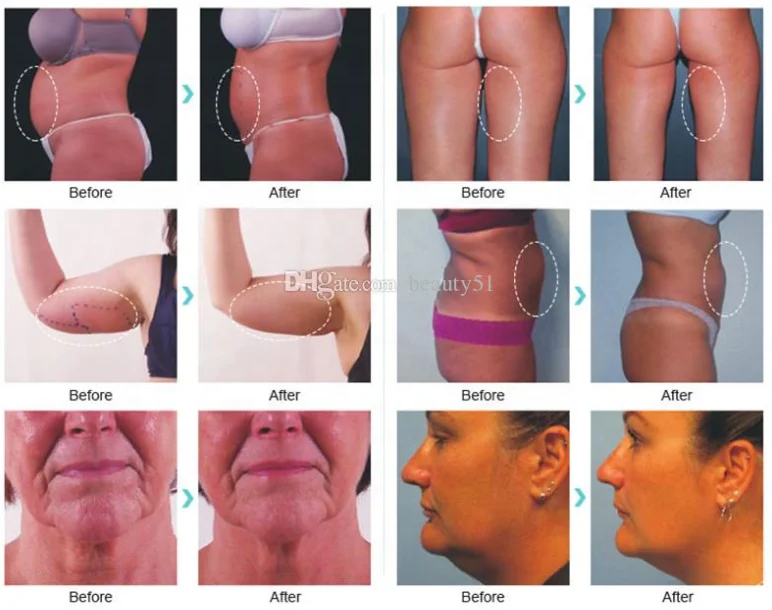 Facelift 1470nm machine endolaser facial laser lifting skin tighten