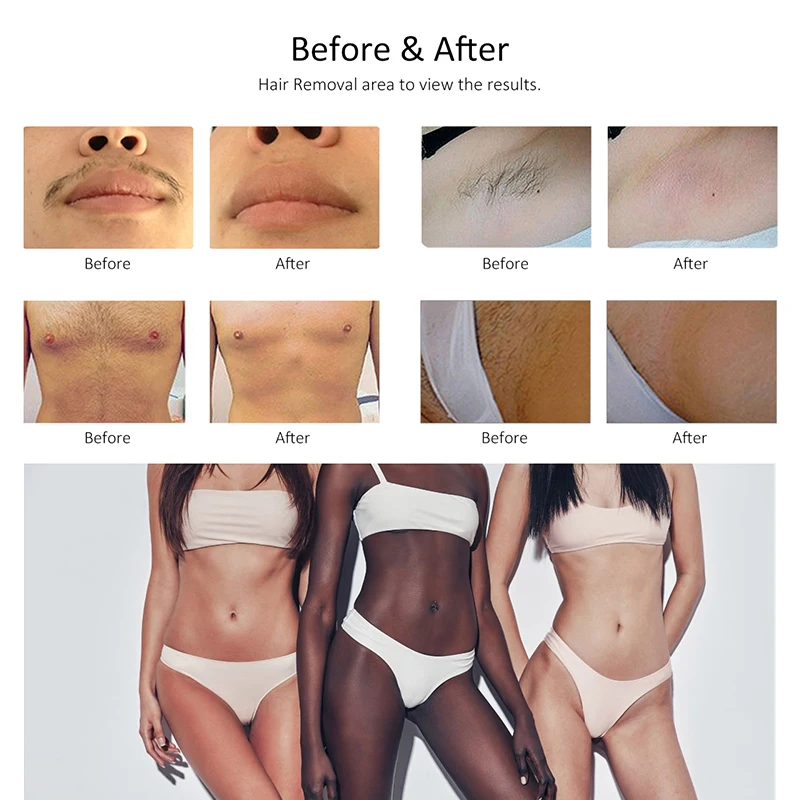 Skin Rejuvenation Ice DCS 4 Wavelength 755 1064 808 940 Winkonlaser Diode Laser Hair Removal Machine