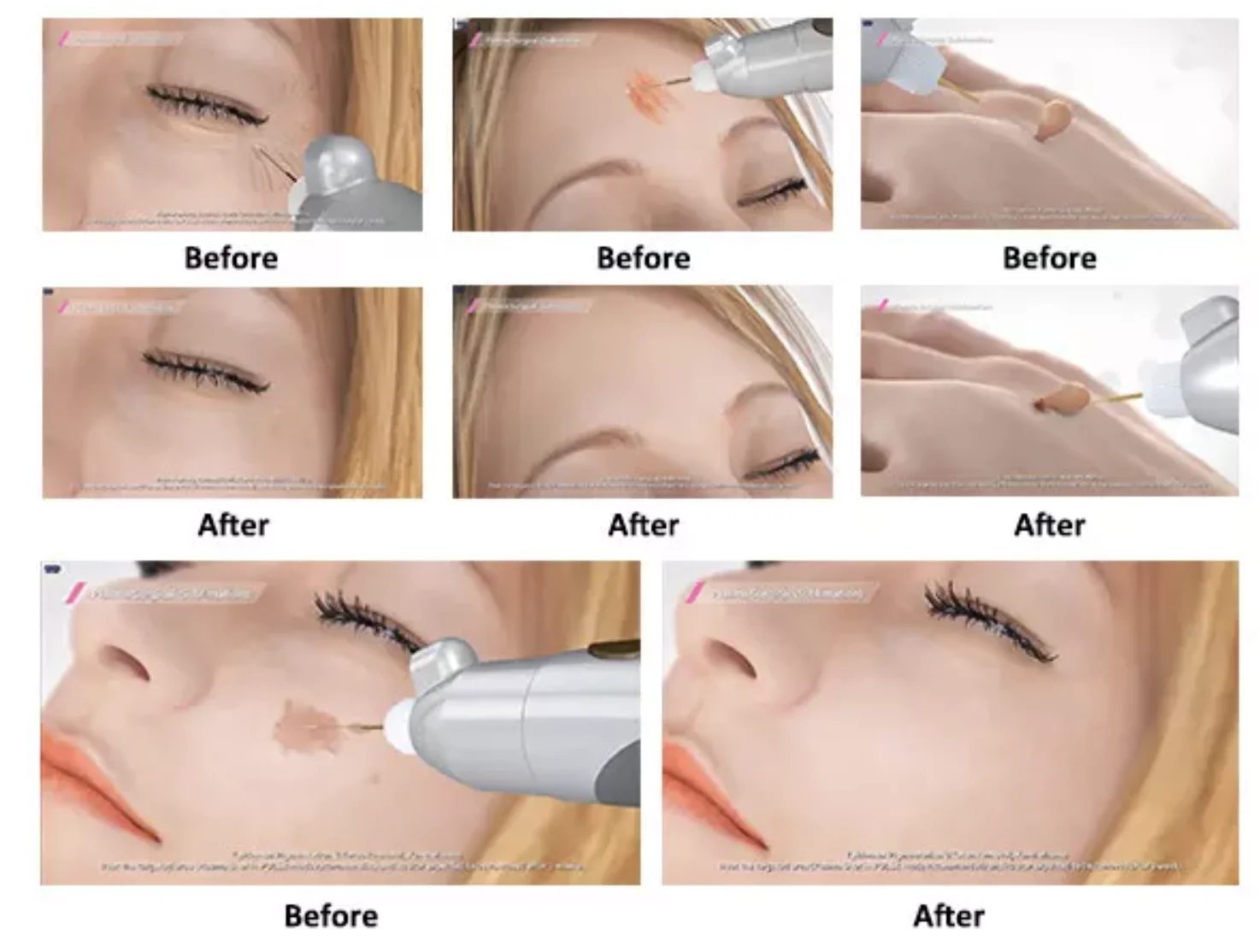 Medical 3 in 1 fibroblast ozone plasma pen jet plasma lift eyelid plasma shower for acne scar removal skin tightening