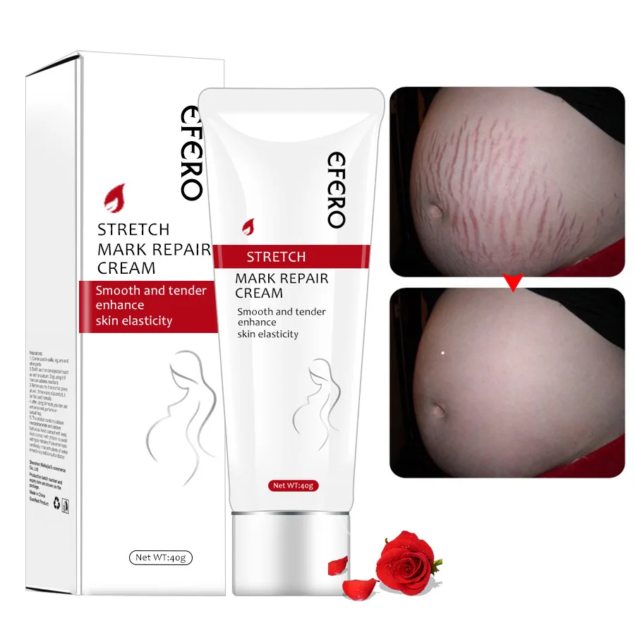 
Organic Natural Stretch Marks Remove Acne Scar Treatment Cream For Pregnancy Repairing Scars for Women Private label 