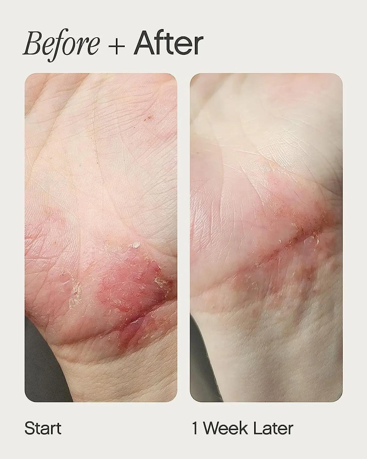 Topicals Like Butter Moisturizer for Dry, Sensitive & Eczema-Prone Skin - Soothing Instant Moisturizer