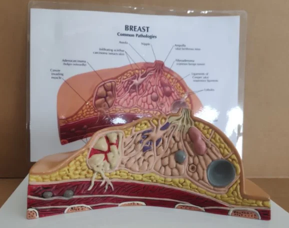 Pathological models of the breast on the anatomy of medical diseases and cancers Models of the female breast