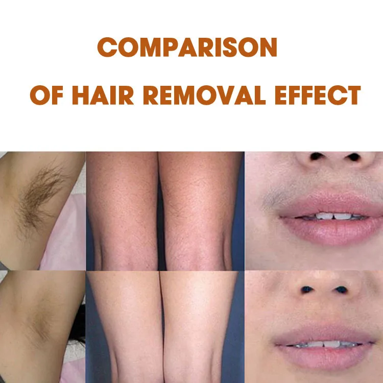 2024 Newest Ice Platinum Titanium 1600W Diode Laser 808 Diode Laser Hair Removal Machine Price