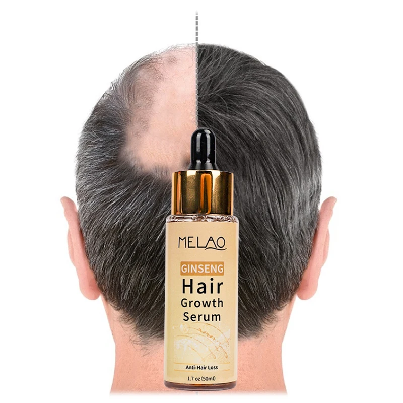 OEM 100% Pure Natural Organic Scalp Essential Oils Anti Hair Loss Product Ginseng Hair Growth Serum