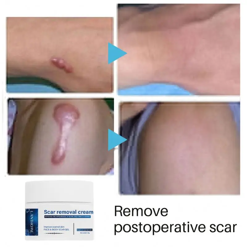 30g Old And Dark Spot On Leg Removal Cream Remove Postoperative Effectively Prevents Scar Proliferation After Surgery