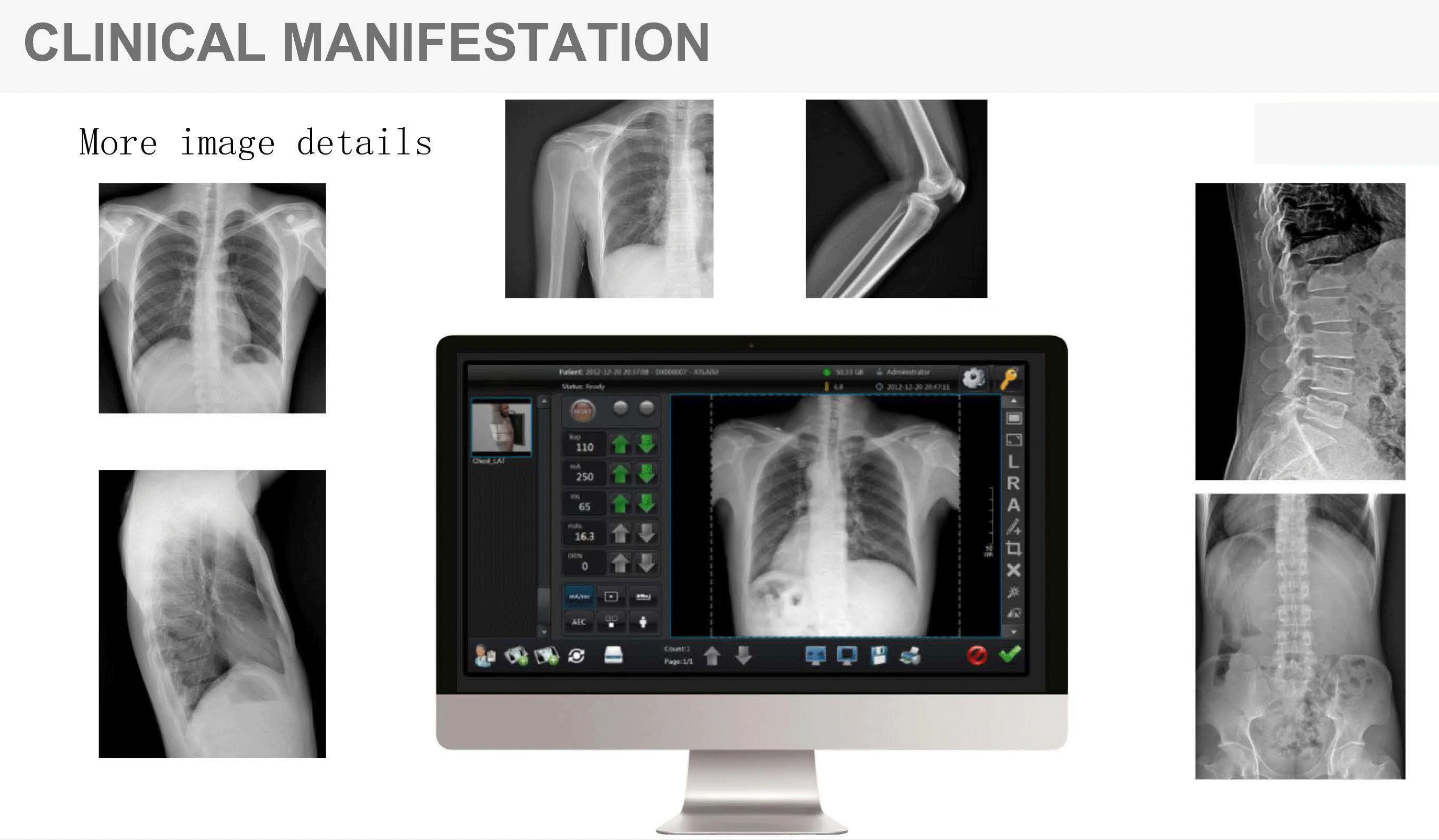 1417 Wireless digital X-ray flat panel Detector for radiography DR system