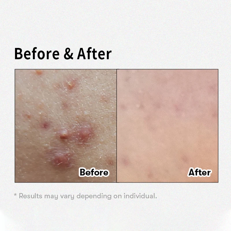 OEM COSMETICS Reedle Shot 700 Essence Ultimate Facial Essence Skin Refining Instant Skin Care Centella Complex Hyaluronic Acid