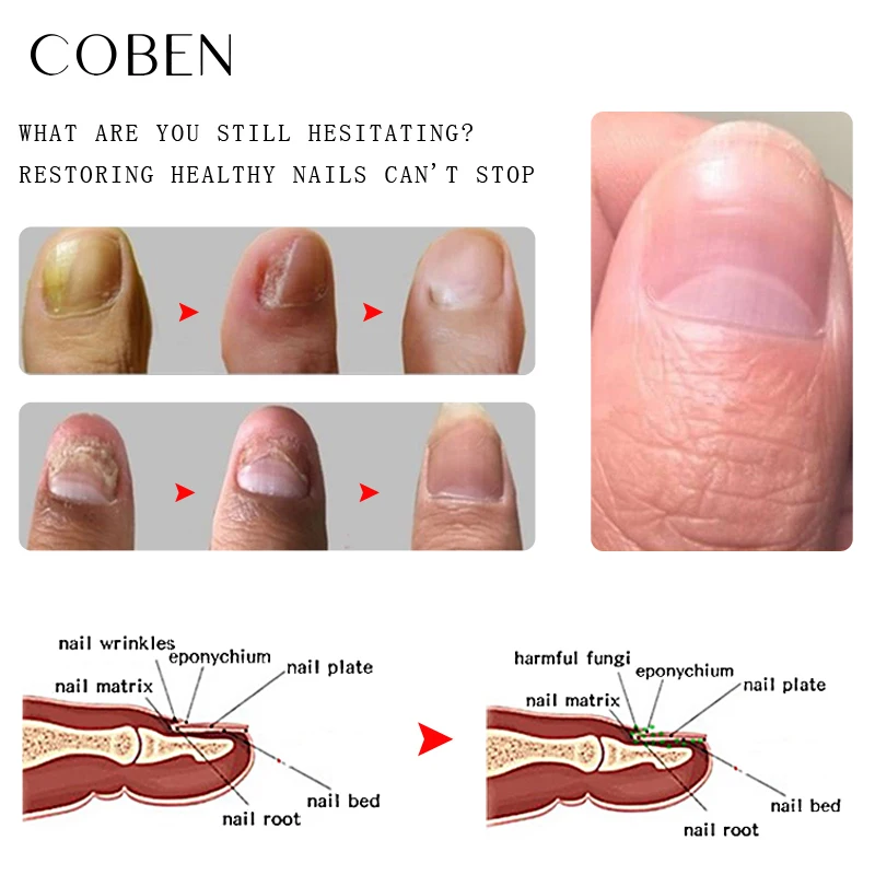 Treatment Nail Repair Pen For Onychomycosis Paronychia Finger Toenail Fungus Infection