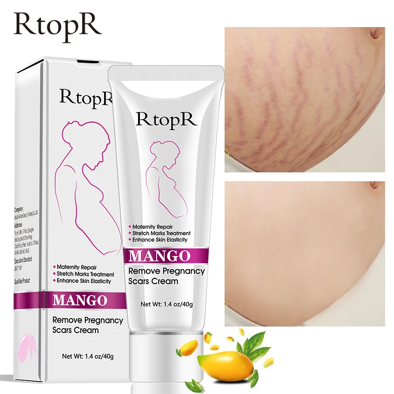 RtopR Amazon Hot Sale Best Natural Organic Mango Anti Vergeture Repair Scar Stretch Mark Removal Cream