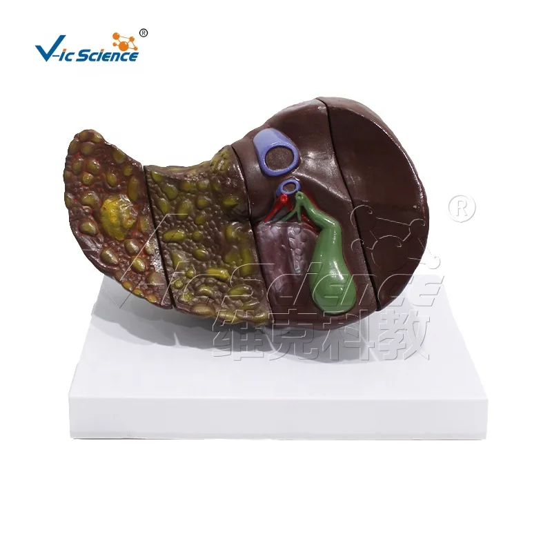medical science Liver cancer anatomical model Four stage pathological liver education model