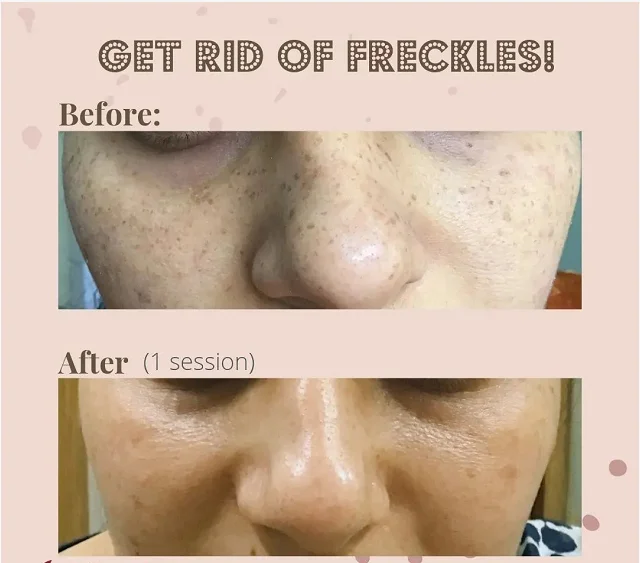 Sincoheren 1064 nm 532nm Q Switch Nd Yag Laser Tattoo Removal Aesthetic Technology Equipment for Medical Clinic