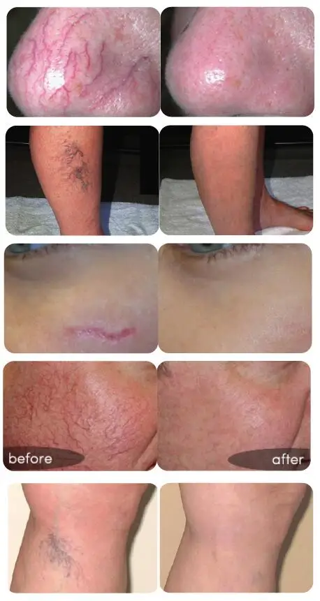 VELASII-30B Varicose Vein Laser/Medical CE/ Veins Removal Laser Machine