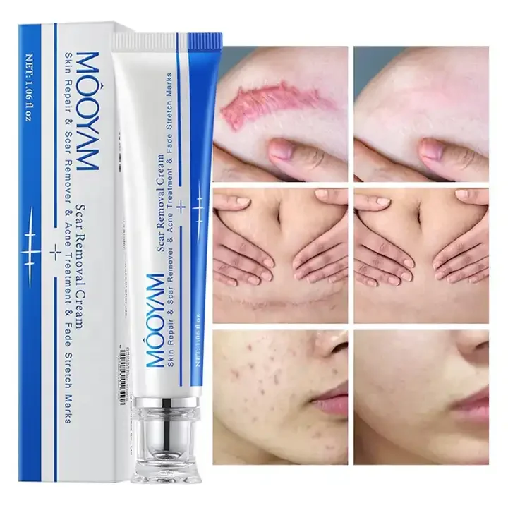 Fastest Acne Scar Removal Cream Face Care Scar Gel Bruise Repair Cream Tummy Tuck Tightening 30g Stretch Mark Scar Removal Cream