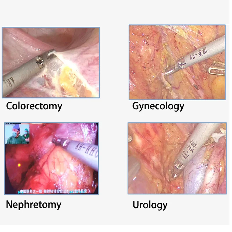 Affacare surgical equipment ultrasonic surgery surgical instruments thyroid surgical instruments of adenotomo