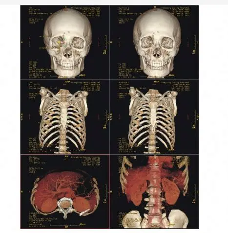 11X14inch High definition medical white film that can be viewed directly No need for film viewing lights  for PANTUM Printer