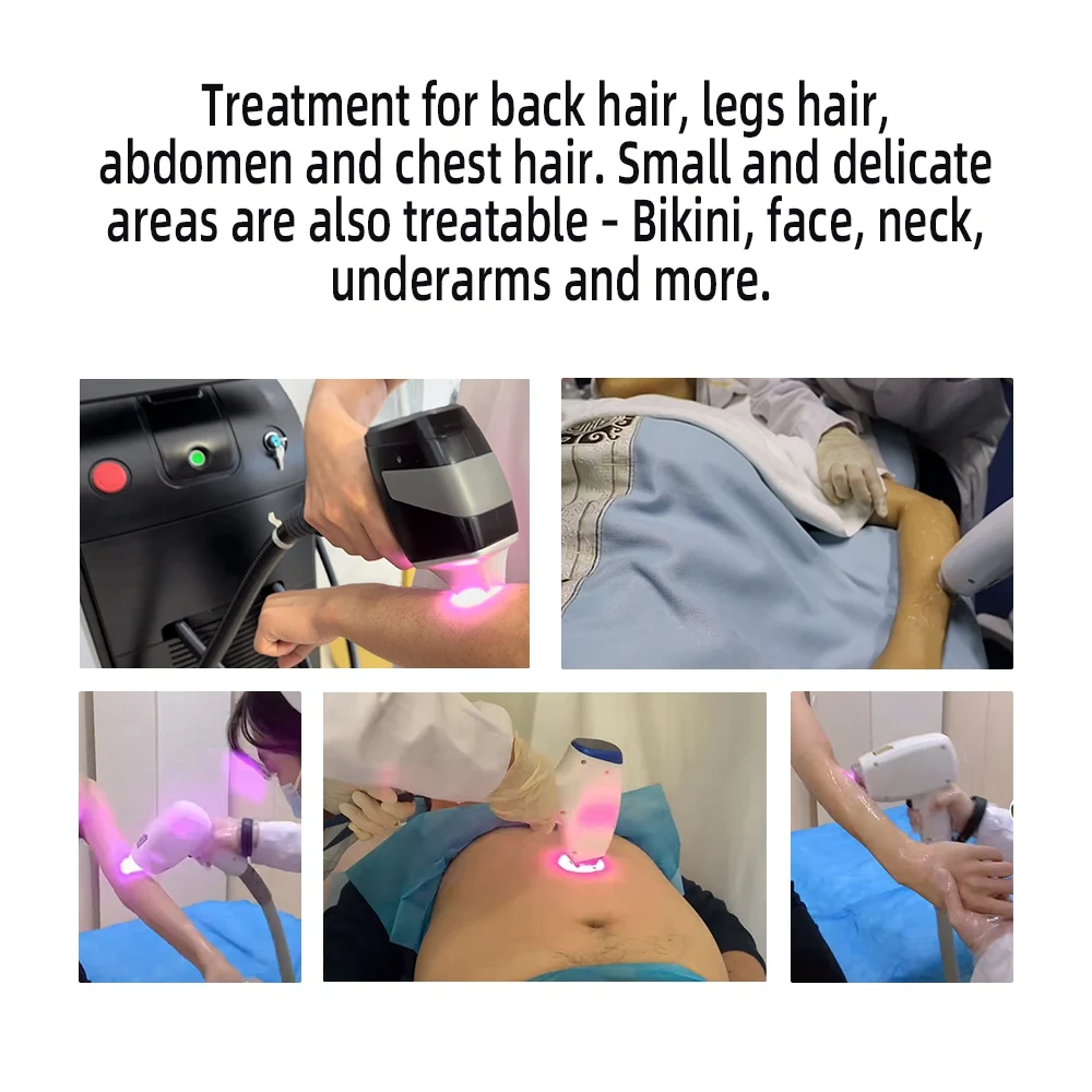 2023 New Design TEC Ice Cold Hair Removal Machine 755nm 808nm 1064nm Laser Hair Removal