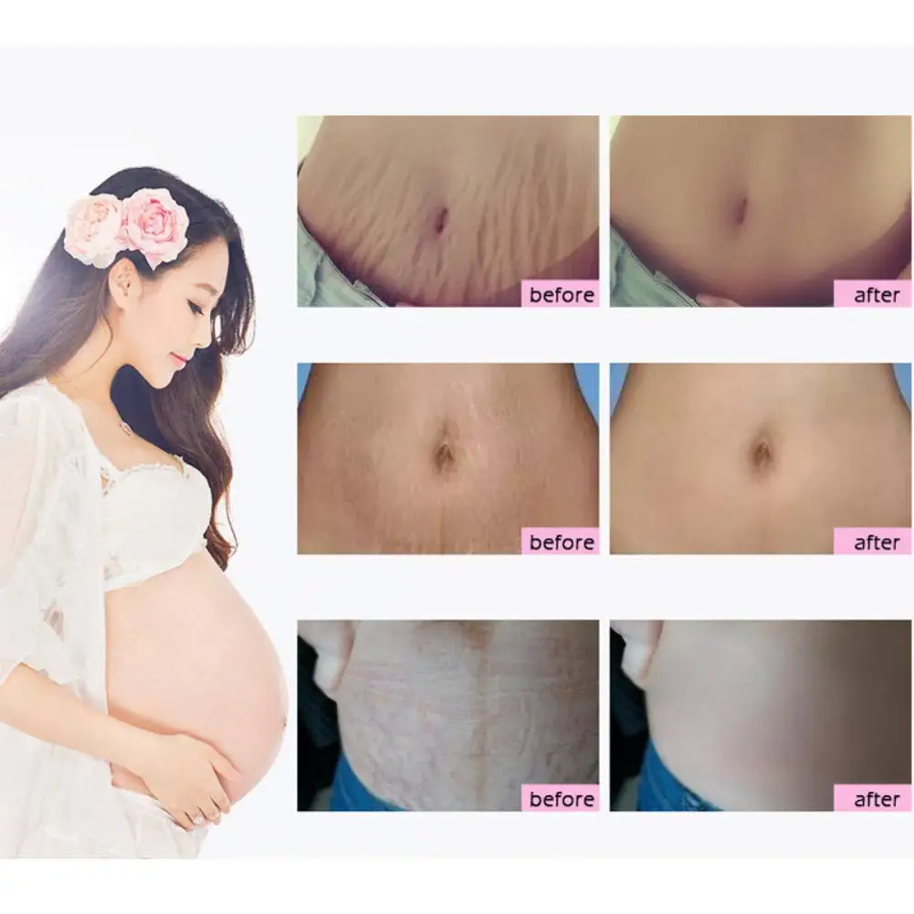 Skin Care Product Private Label Stretch Mark Repair Scar Slack Line Abdomen Effective removal Stretch Mark Cream