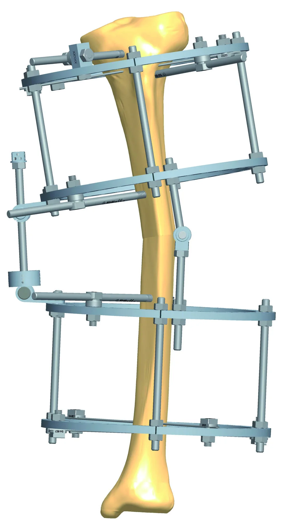 
Hot Sale Black Stainless Steel Elbow Joint External Fixator 