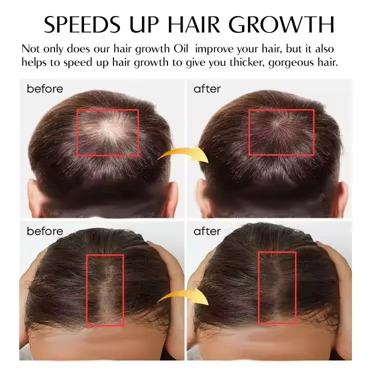Private Label Natural Biotin  Hair Growth Oil Hair Regrowth Treatment Scalp Care Massage Hair Scalp Oil