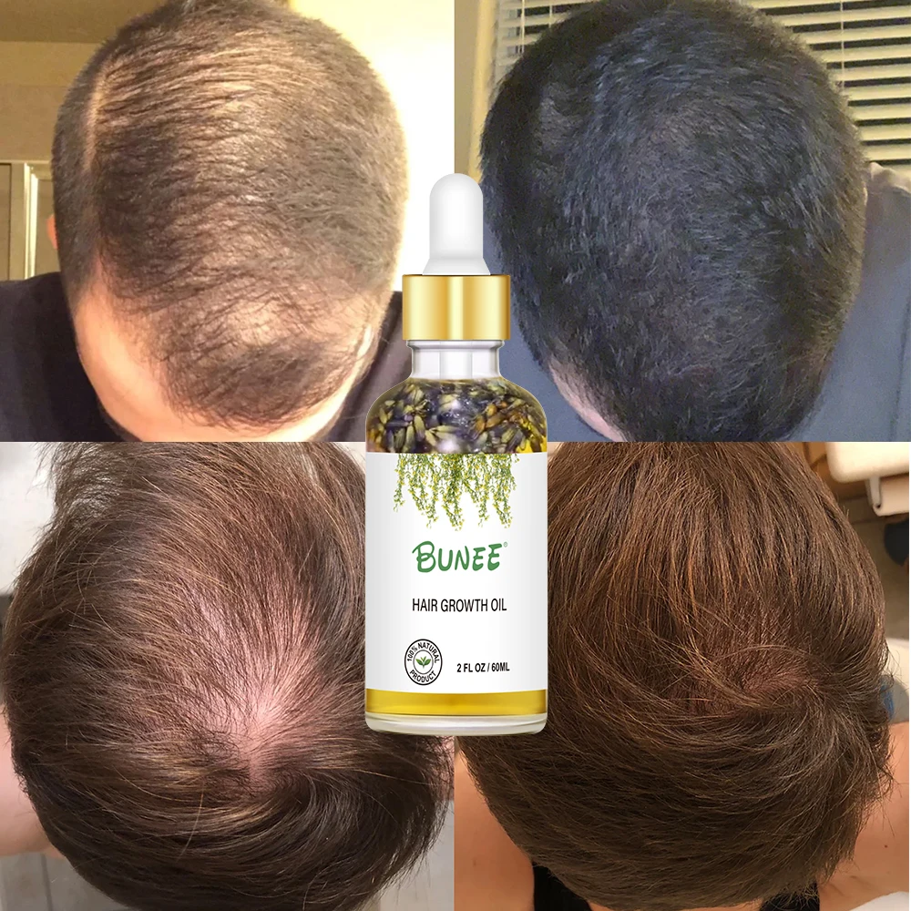 Build Your Own Label Organic Hair Regrowth Treatment Regrowth Serum Anti Hair Loss Lavender Hair Growth Oil