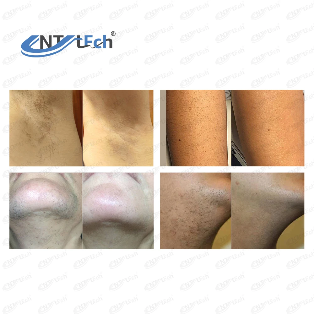 808 diode laser hair removal machine for sale promotion price