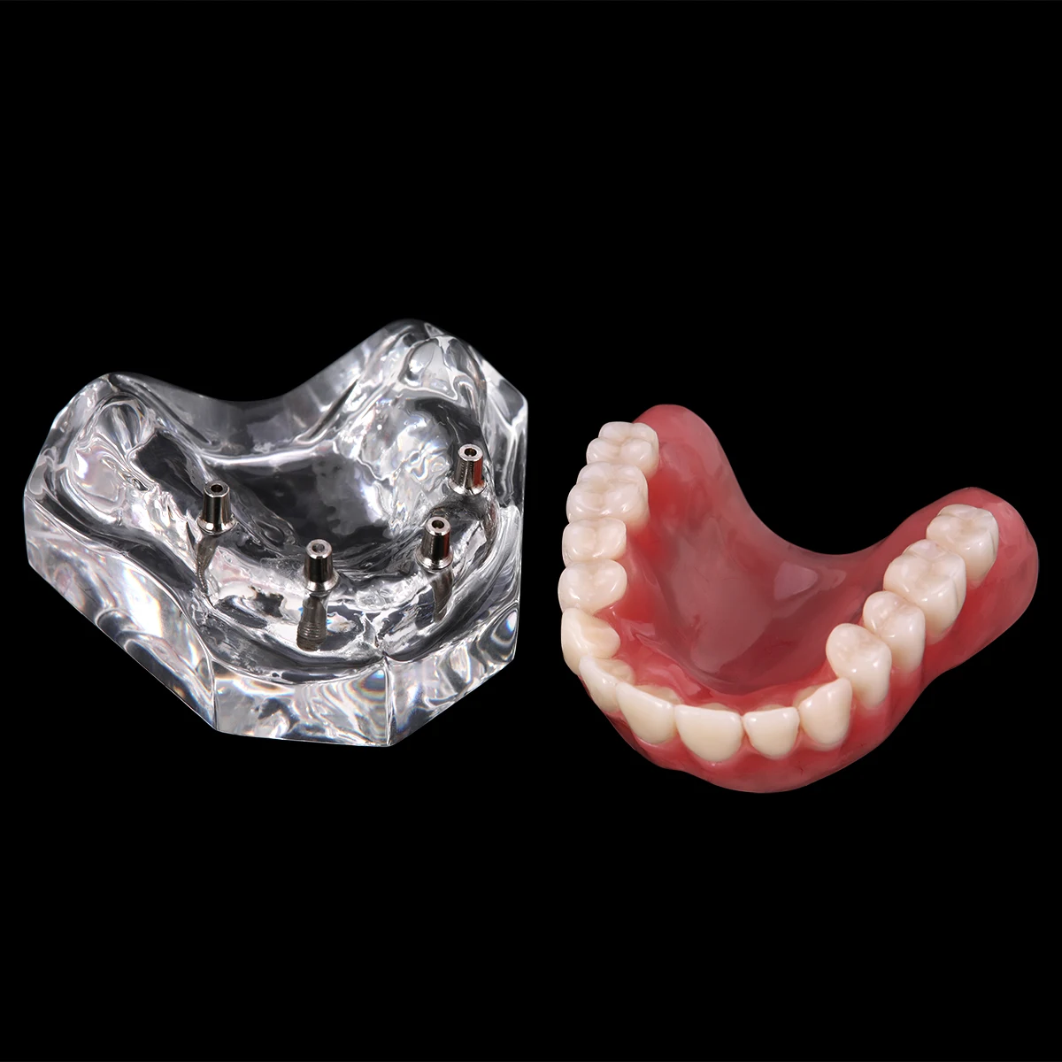 Hot Selling Dental Implant Teeth Model Overdenture Restoration with Implants Upper