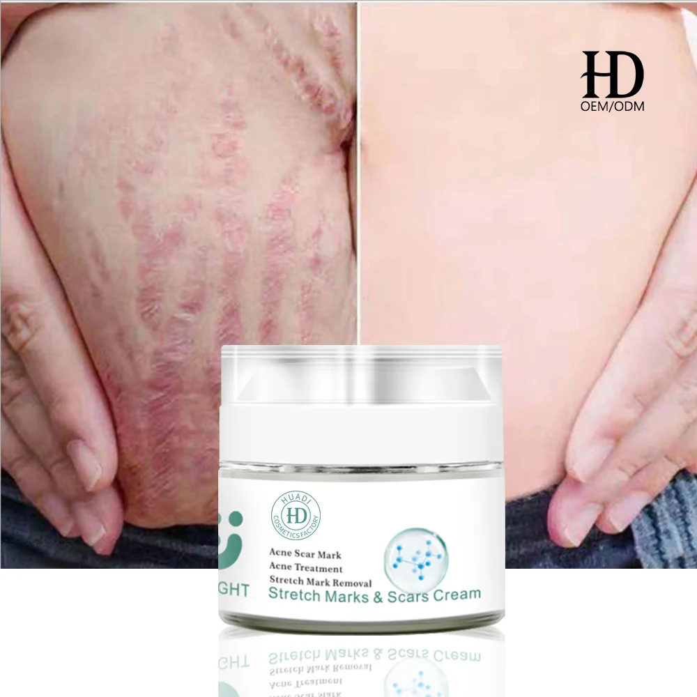 OEM/ODMHerbal extracts Pregnancy & Scar Removal stretch marks scar removal cream Maternity treatment Stretch Mark Cream